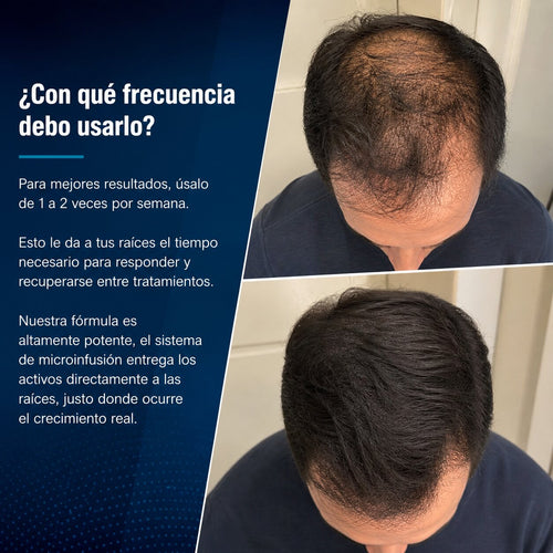 Alfavita™ Sistema Regeneración Capilar (4 meses)