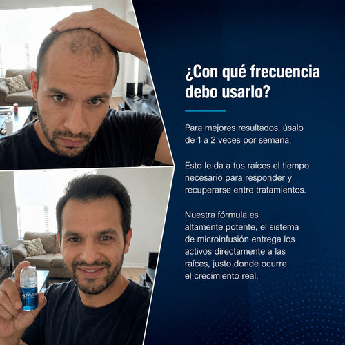El sistema completo para la caída de cabello en hombres